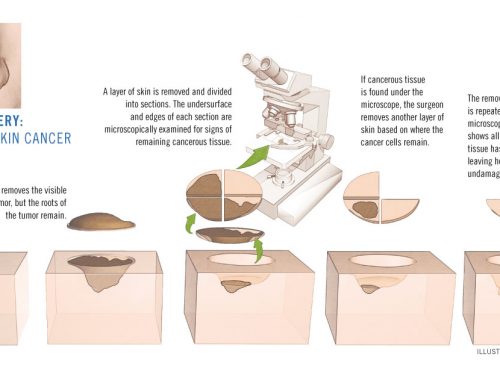 An Overview of Mohs Micrographic Surgery